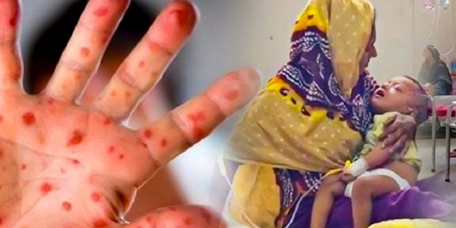 দেশে গত ২৪ ঘণ্টায় হামের উপসর্গ নিয়ে চার জনের মৃত্যু হয়েছে
